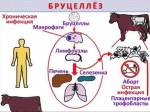 Бруцеллез.